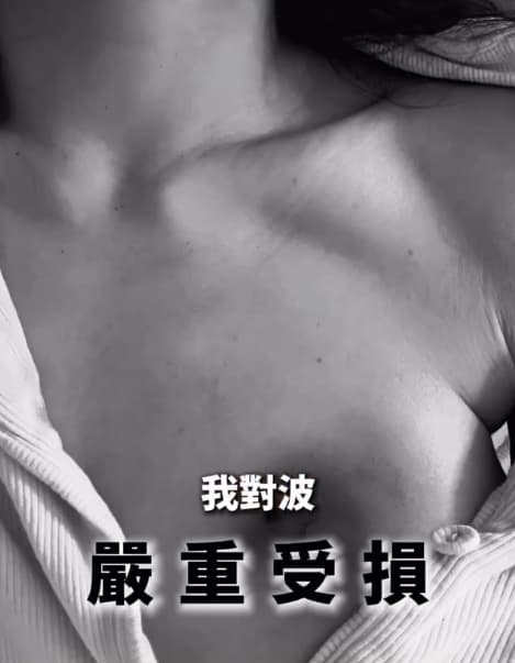 香港「最強小三」鍾睿心胸部被燙傷留下疤痕,還出現傷口感染。(翻攝自IG@5kidsokma_no1fans)