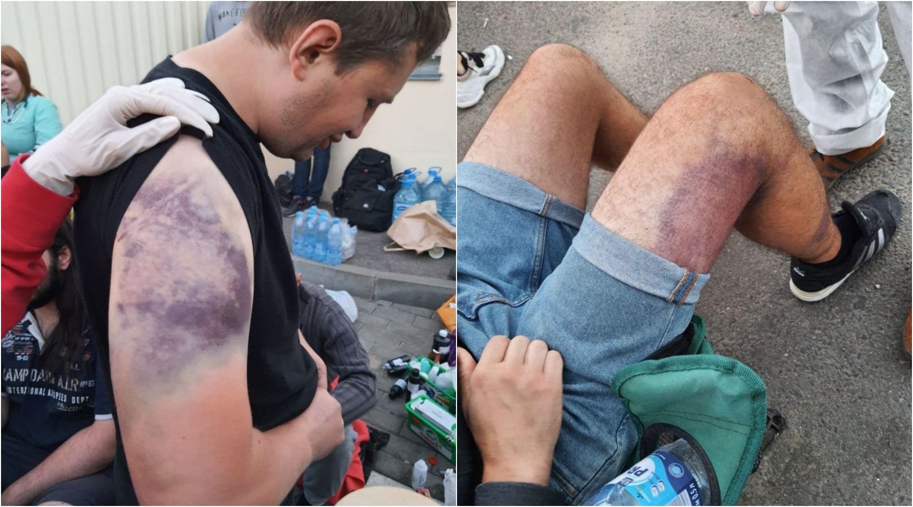 民眾指控被警察拘捕毆打虐待,秀出身上的傷痕。(翻攝https://www.svaboda.org/)