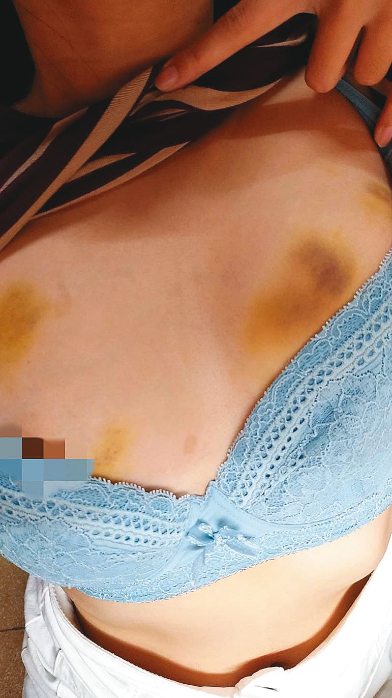 謝男前女友小玉控訴，謝男只要動怒，就會動手打人，她胸前的一片瘀青，就是謝男施暴的結果。（讀者提供）