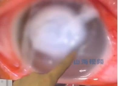 男子新婚夜忘摘隱形致角膜嚴重感染,險些失明。(翻攝自山海視頻)