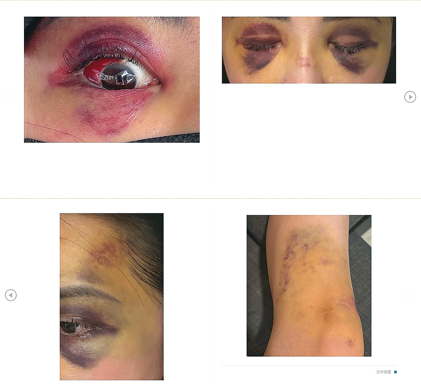 受害人出示傷勢照,除了左眼結膜出血外,雙眼更瘀青如熊貓,身體也有多處挫傷。(A女提供)