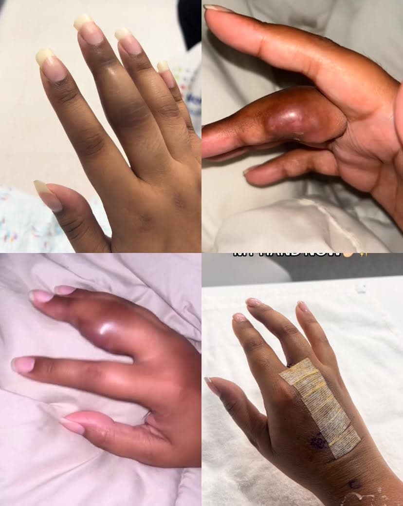 娜塔莉手指腫脹發黑,就醫後確診為腫瘤,最後不得不截肢保命。(翻攝抖音@princessnatixo_)