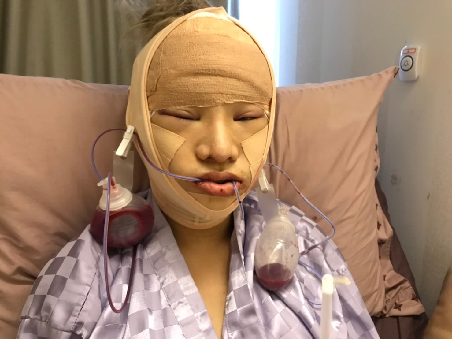 小A辣經歷多次整形手術,至今都還想再繼續優化外型。(小A辣提供)