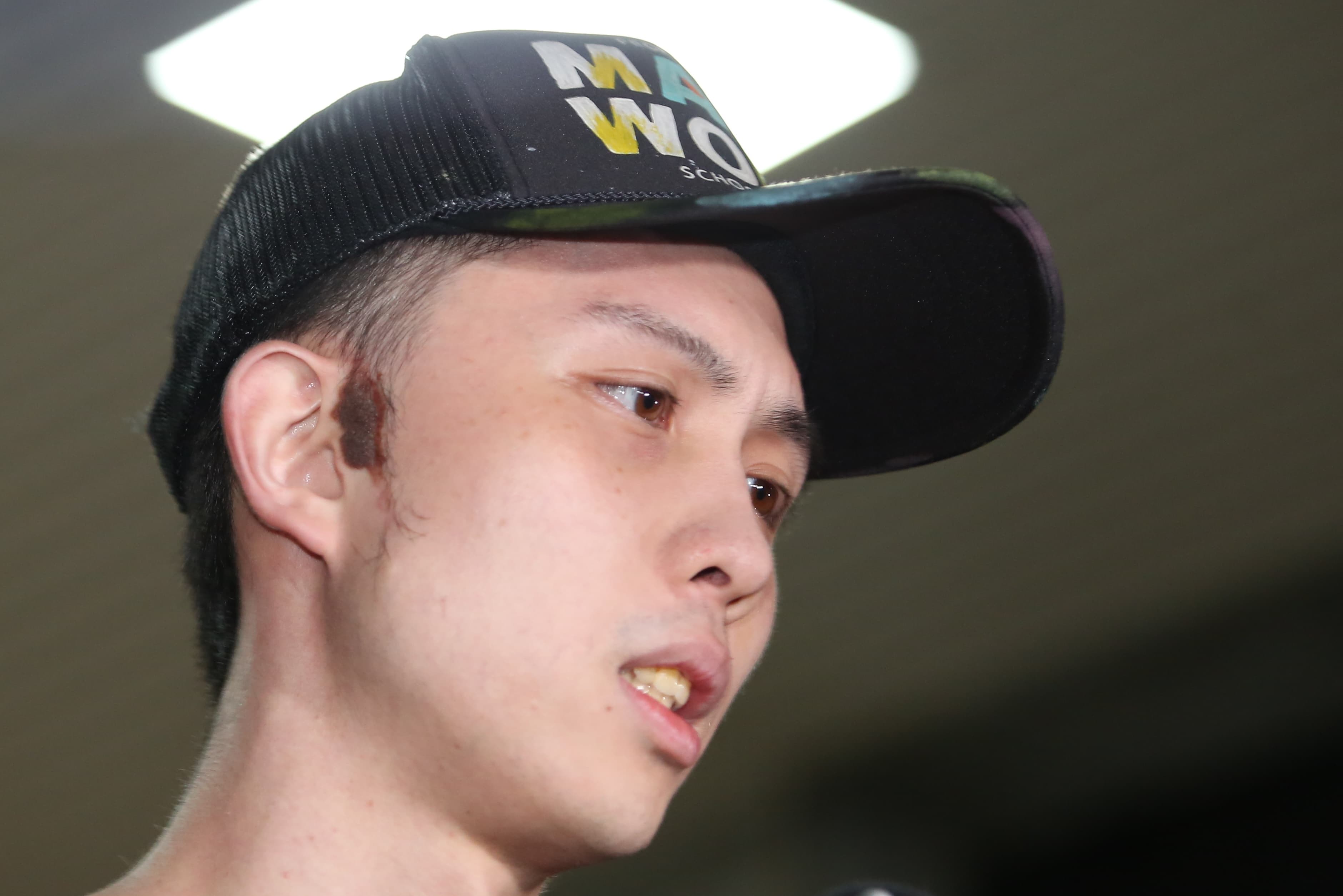 孫安佐右臉胎記一度被認為是傷痕,實際是胎記。(鏡報姜永年攝)