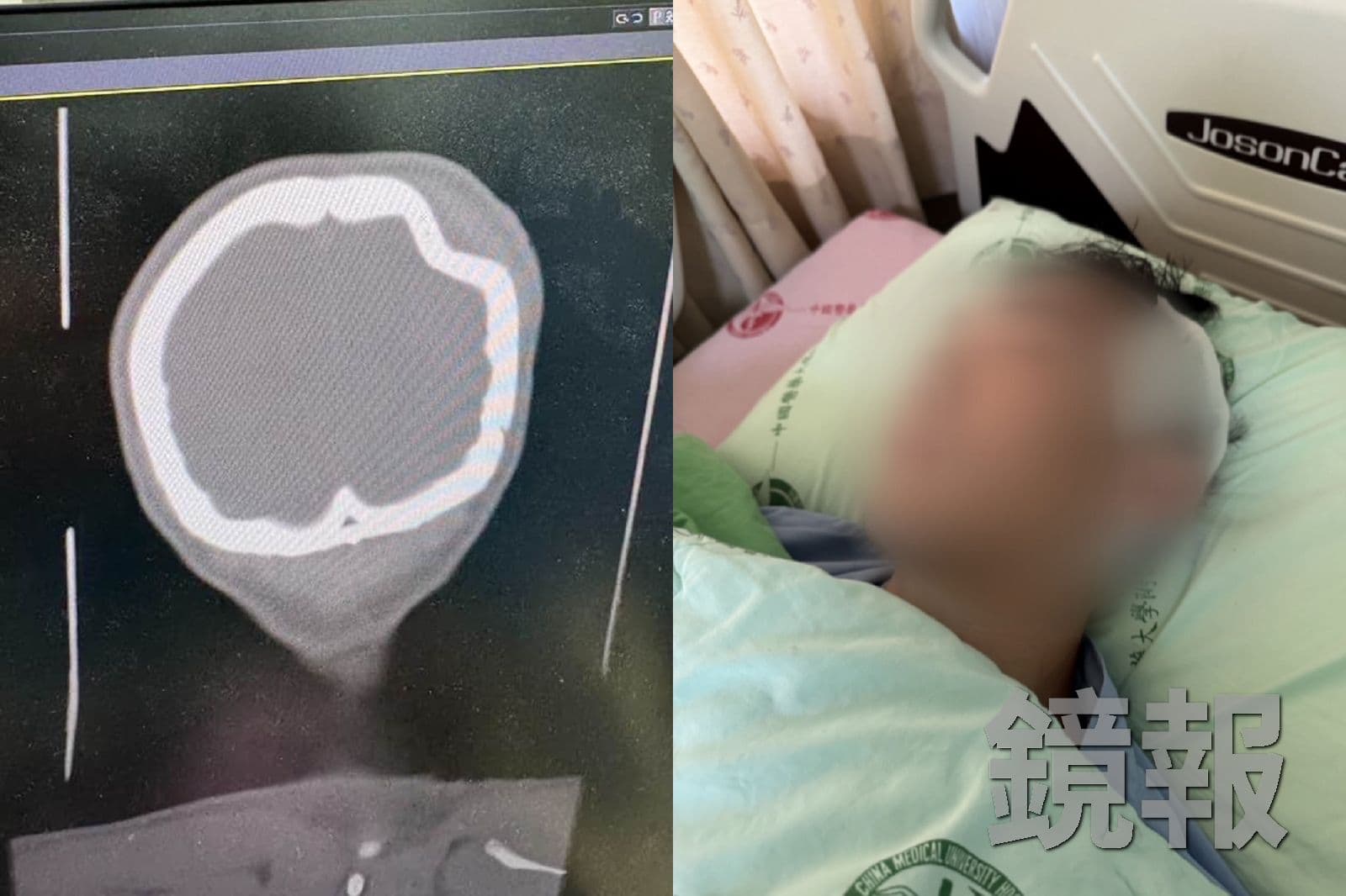 台灣體大競技系陳姓學生顱骨明顯凹陷骨折(左),進行開顱手術才發現,顱骨已碎成許多塊,宛如拼圖。家屬提供