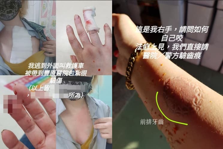 前空姐曬出傷照,揚言要對婆婆和對簿公堂。(翻攝自臉書社團爆料公社)