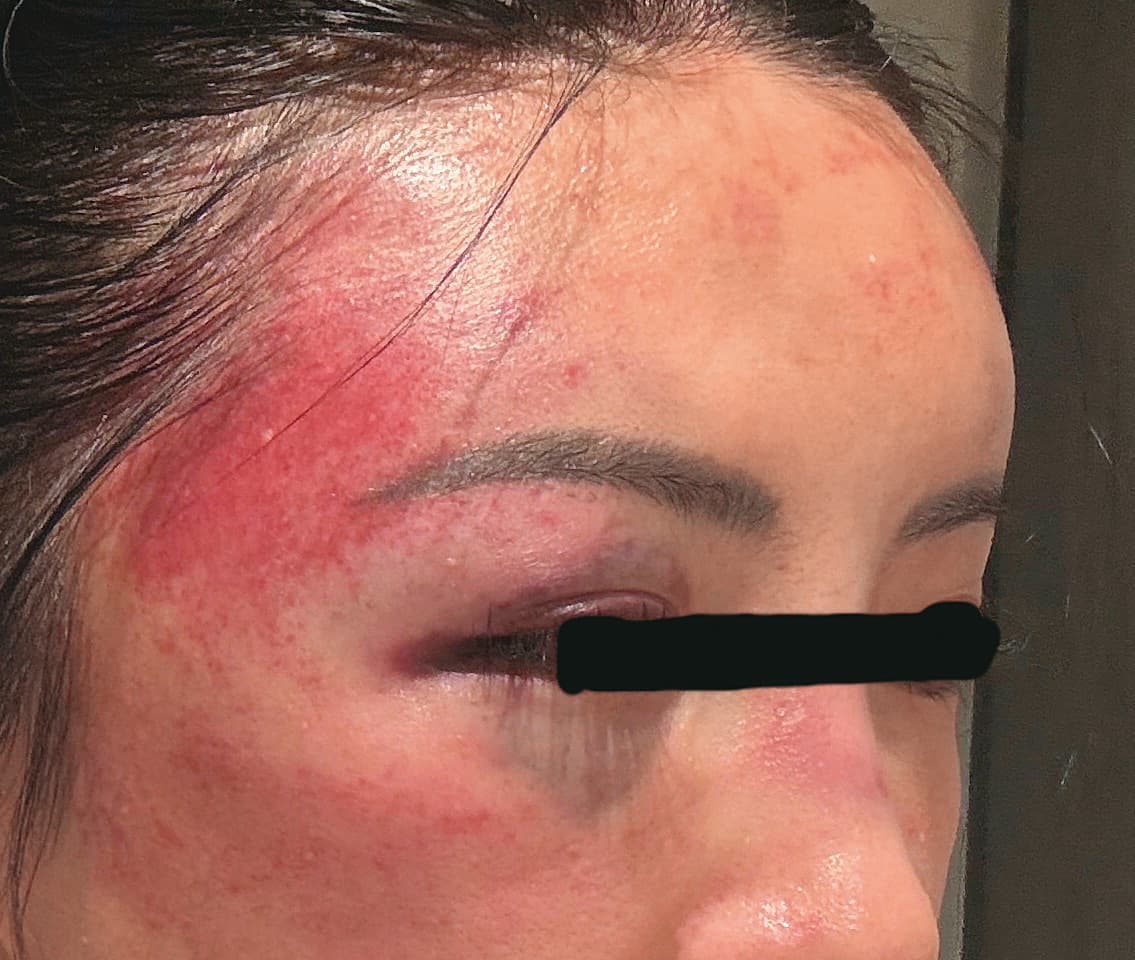 受害人遭許可宗用拳頭猛揍臉部,幾乎要面目全非。(A女提供)