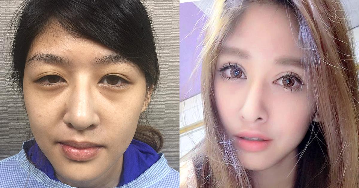 美麗分享見證 一 經過專業醫師推薦，打造出只有吸引力、沒有殺傷力的迷人雙眼 <首席醫美授權提供>