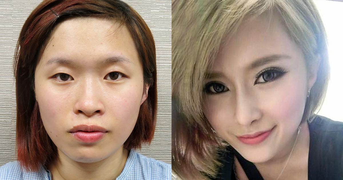 美麗分享見證 二 經過醫師專業建議，變身為五官立體美女。 <首席醫美授權提供>