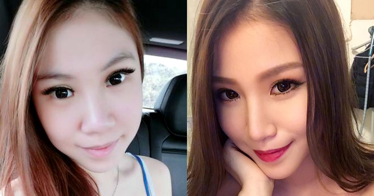 美麗見證(二)：經過醫師專業建議，擁有完美挺鼻，成為萬人迷。 (首席醫美授權提供)