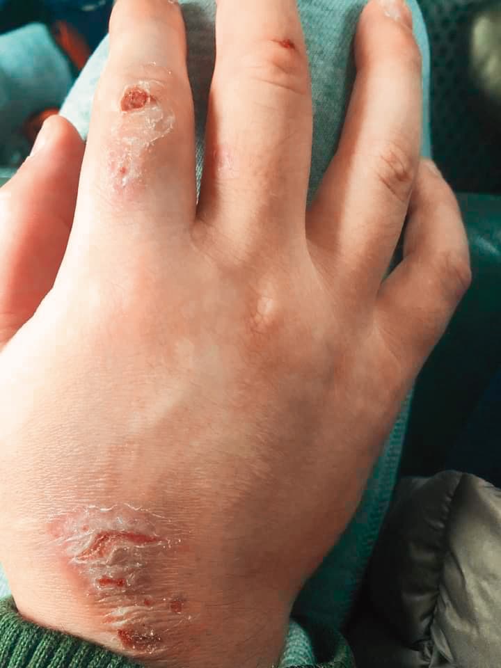 王幼玲的兒子一焦慮就搓手,最近他把自己的手搓得皮開肉綻,仍無法停止。(王幼玲提供)